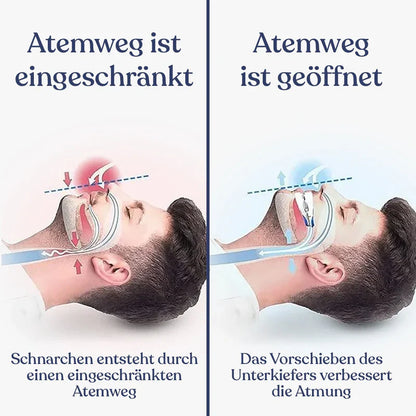 Anti-Schnarch-Schiene (Zahnschutz)